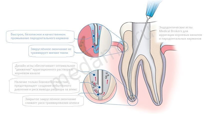 Чем промывают каналы. Протокол ирригации корневых каналов. Эндодонтическая игла для ирригации корневых каналов. Методика ирригации корневых каналов зуба. Протоколы эндодонтии ирригации.